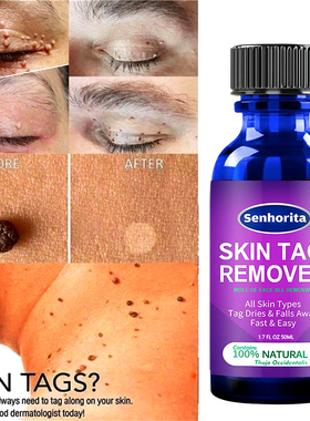 Skin Tag Remover Agat Mole & Genital Wart fast RemovWithin