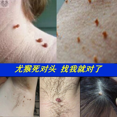 去猴子脖子上长的小肉粒疙瘩克尤液瘊去庞瘊猴子肉粒疙瘩一抹无忧