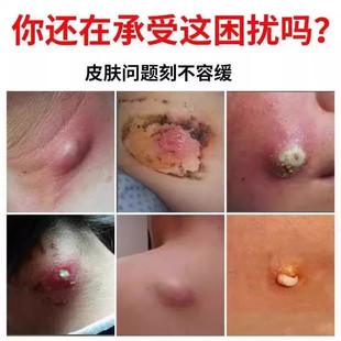 石京火疖子膏拔毒拔脓膏治大脓包硬块屁股上坐板疮长痘痘红肿疙瘩