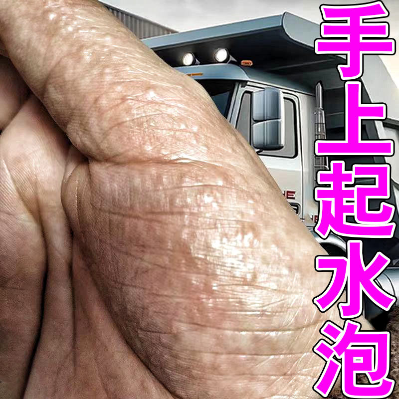 手上起小水泡皮肤凸起小疙瘩抓痒刺挠汗疱泡疹湿疹手指头发痒药膏