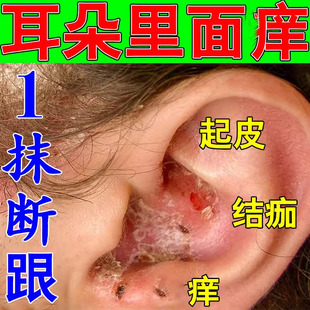 耳朵痒感染真菌外耳道皮屑干燥起皮流脓结痂霉菌性耳道痒专用