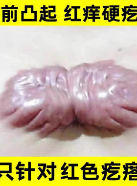 疤痕增生凸起胸前瘢痕去除红疙瘩