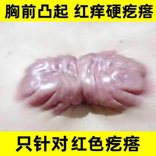 疤痕增生凸起去除胸前瘢痕疙瘩软化针修复烫伤后疤体质痒专用膏贴