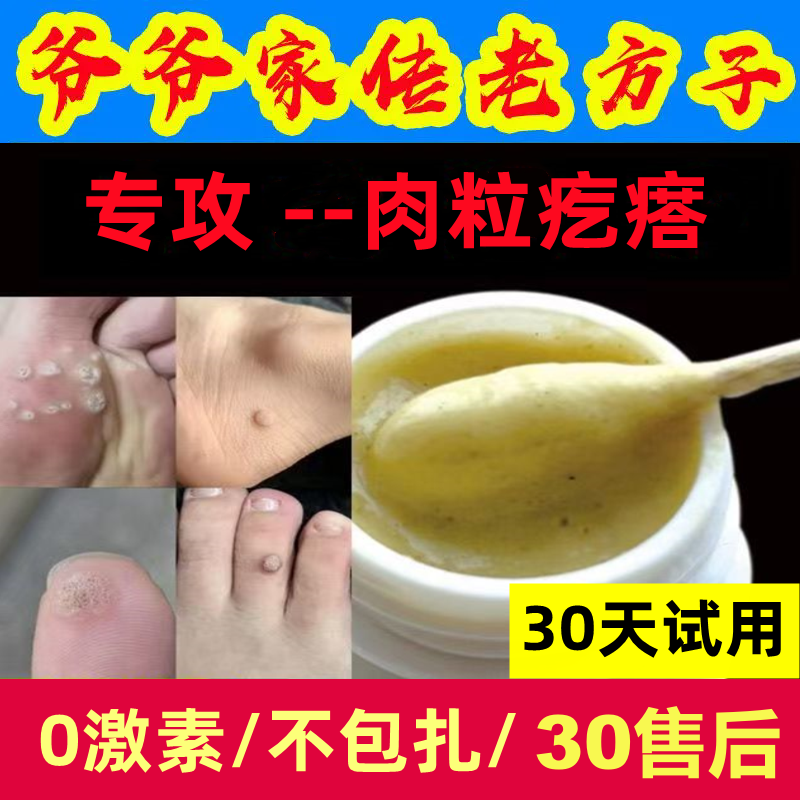 去小肉粒疙瘩肉刺鱼鳞痣斩除草根脚上鸡猴茧子眼贴老茧专用神器