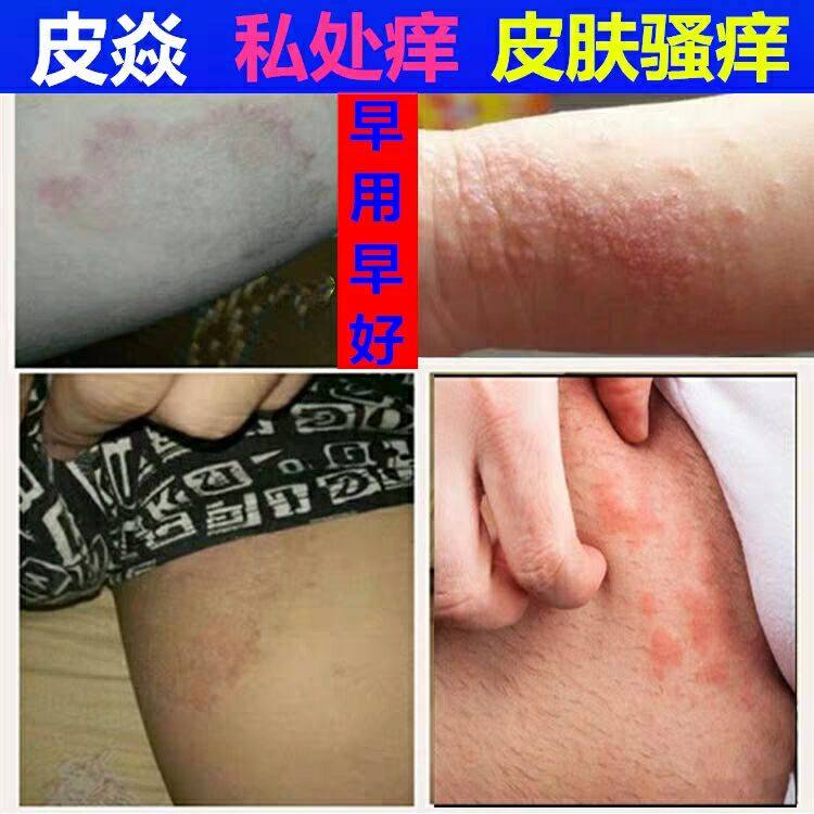 湿疹止痒去根成人外用皮肤瘙痒湿牛皮 癣肛门股 癣内侧阴囊无激素|ruв категории туалетные чище/санитарно - гигиенических салфеток/бумага/Ароматерапия, шампунь/человек чистой, Очистка тела, гель для душа - от Buy2taobao.com для оказания профессиональной услуги покупки агента Taobao