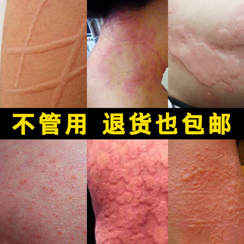 Eczema relieve itching skin Dedicated Scrotum Itching Blister Salve adult External use Hormonein the Care cleaners/Sanitary napkins/Paper/Aromatherapy , Shampoo bath/Personal cleanliness , Body Wash , Body Wash  category - from Buy2taobao.com to provide professional Taobao agent buy service