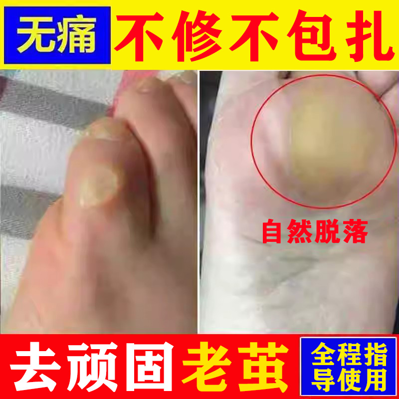 去除脚老茧脚茧软化剂小脚趾茧子