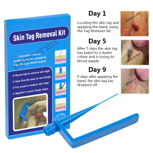 Tag Home Set Equ Use Remover Wart Skin Mole Kit Blue Removal