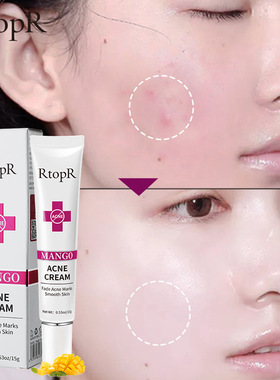 Mango Acne Removal Face Cream Whitening Shrinks Pore痘痘面霜