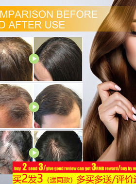 Biotin Hair Growth Spray Anti Dandruff Itching beard头发喷雾