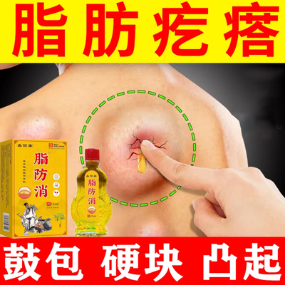 脂肪疙瘩膏身上有鼓包大小硬块凸起皮下硬肿块凹凸不平专用油