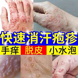 汗疱药疹止痒膏去手痒脱皮起小水泡根专特用效乳膏软膏鹅掌风乳膏