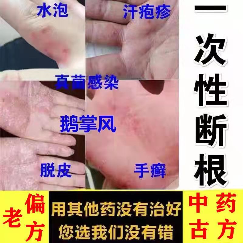 手足藓真菌感染汗疱疹汗状汗孢疹脱皮干裂水泡脚痒手气鹅掌风药膏