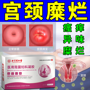 宫颈糜烂重度专用中药消糜栓治疗阴道炎瘙痒异味白带增多妇科凝胶