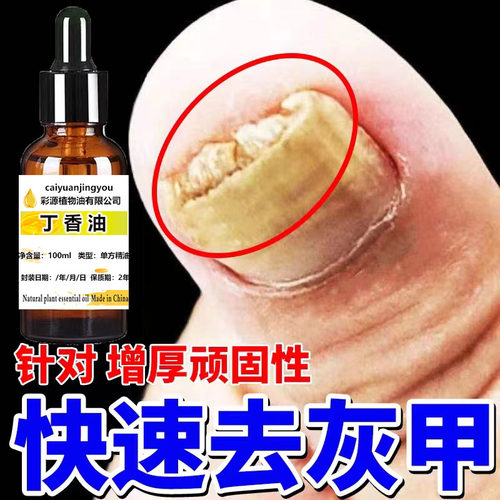 丁香油灰甲灰指甲脱甲增厚发黄黑