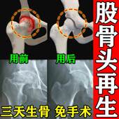 股骨头专用膏药贴 髋关节缺血性坏死积液塌陷尾椎股疼 再生新骨