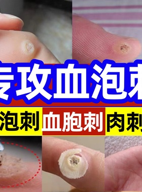 血胞血泡刺去除膏神器跖尤血泡刺去除膏鸡眼膏专用脚钉