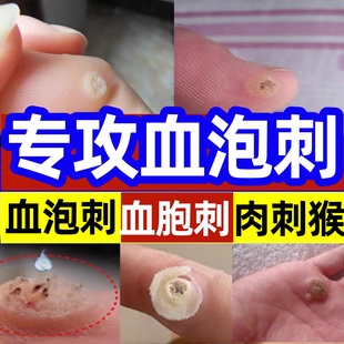 血胞血泡刺去除膏神器跖尤血泡刺去除膏鸡眼膏专用脚钉