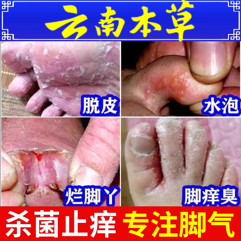 脚气止痒脱皮杀菌烂脚丫药糜烂脚趾缝烂痒云南本草喷剂克真菌星er