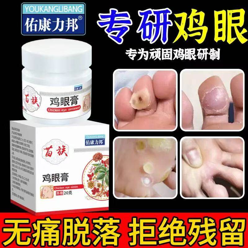 药房正品苗族秘方鸡眼膏老茧瘊子肉刺足底鸡眼抑菌软膏旗舰店yb5