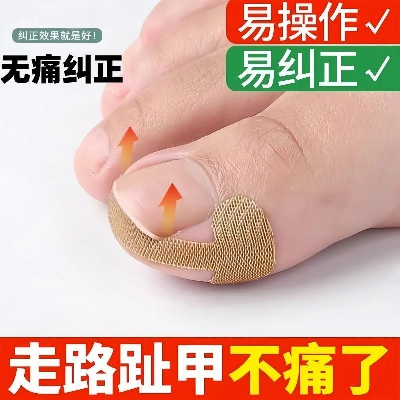 甲沟炎专用矫正贴矫正神器嵌甲专用拉贴隔离脚趾甲长肉修甲剪刀