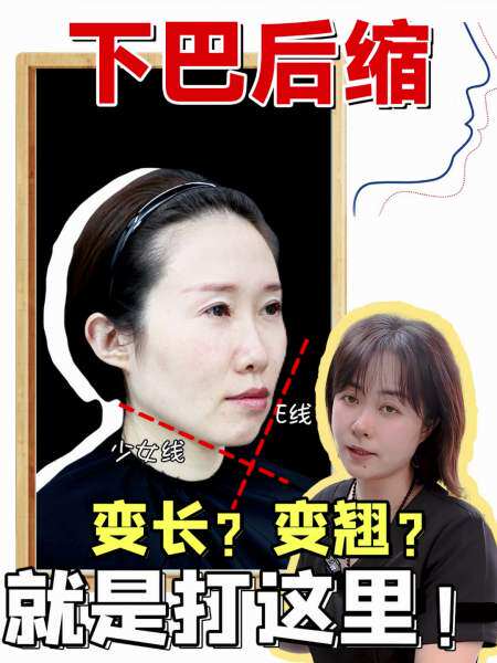 草本下巴增长精华 挺翘变长变尖改善后缩扁平精油