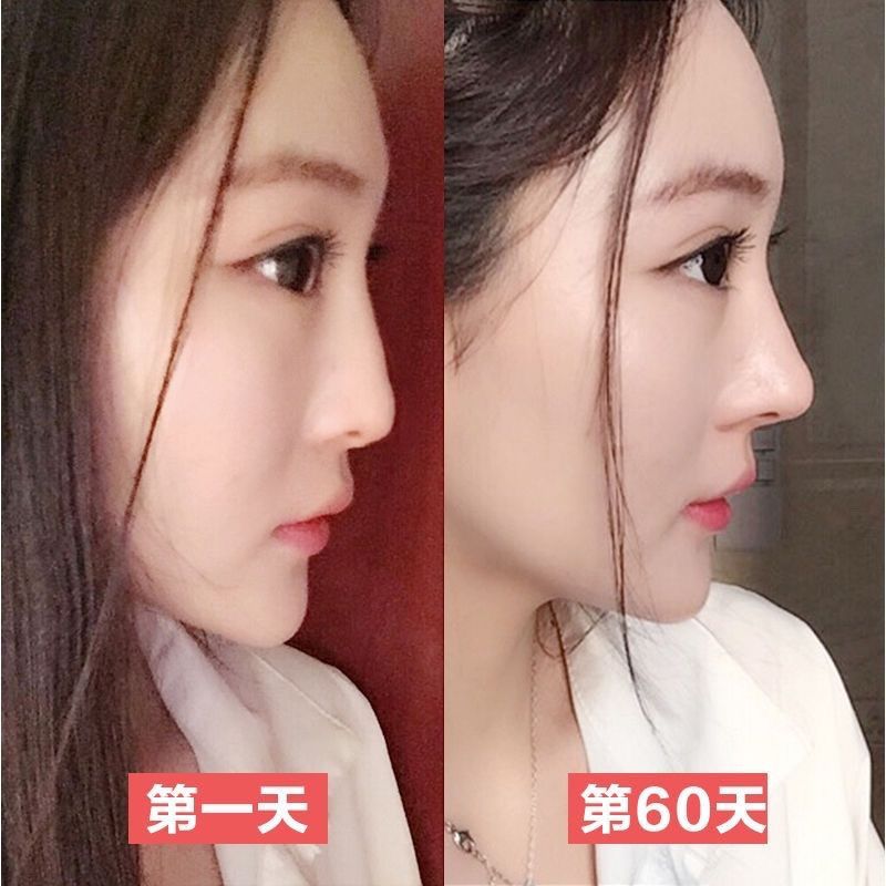 高鼻梁增山根瘦鼻头缩鼻翼女生大鼻头立体挺美鼻神器加强版