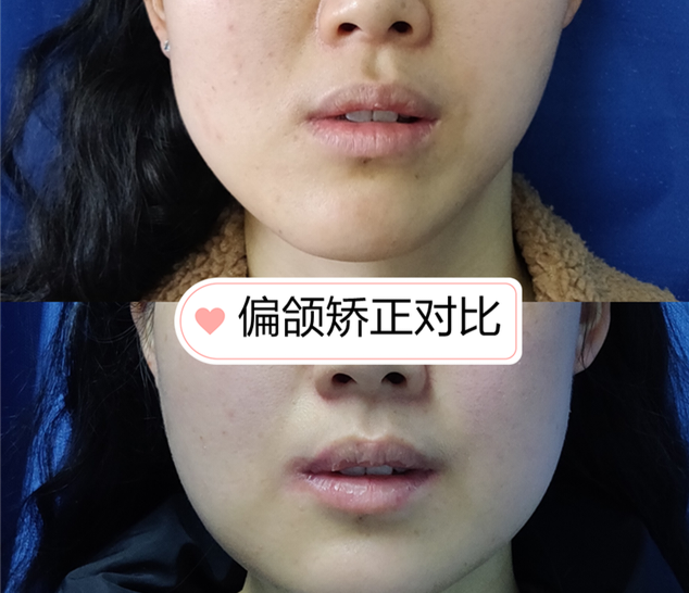 草本偏脸修复精华 改善歪脸矫正下颌线歪斜加强版