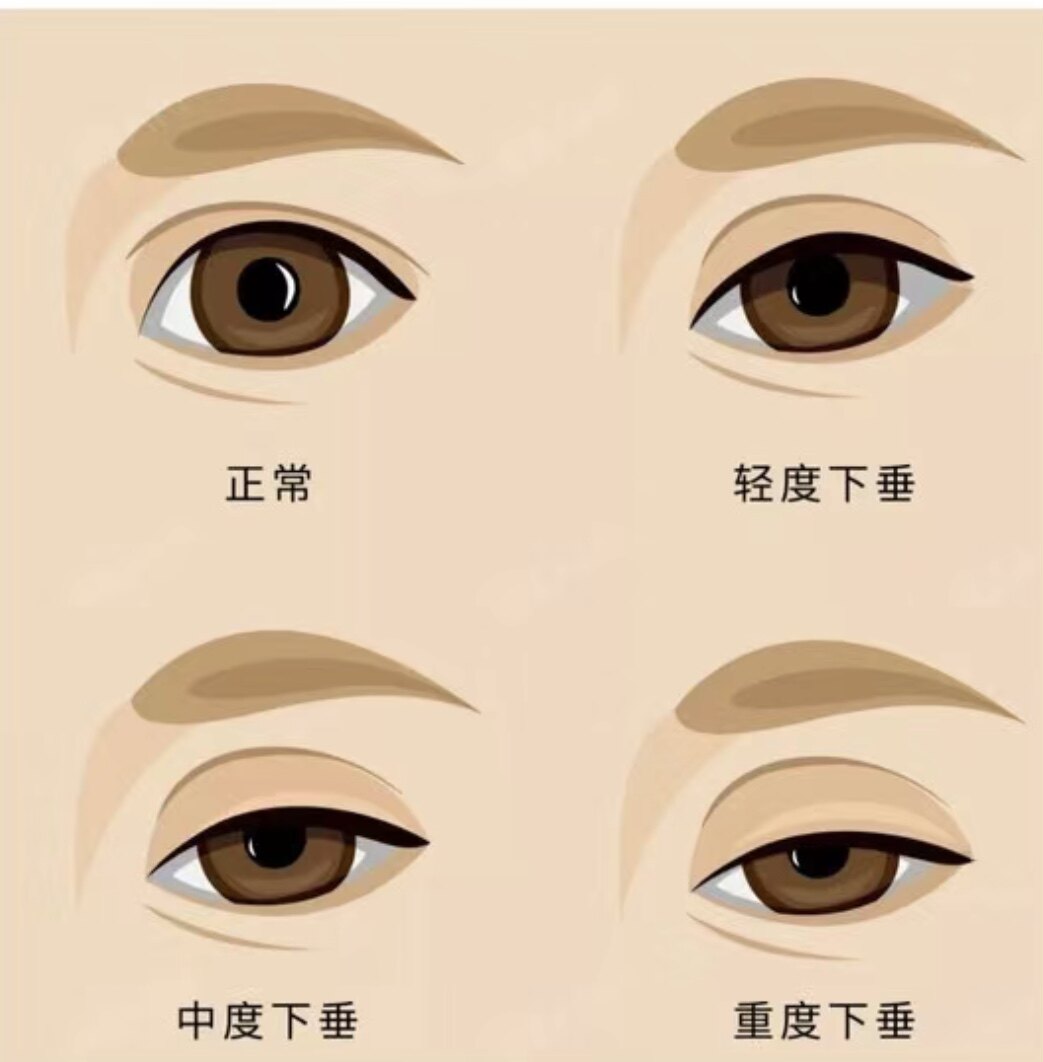 上睑下垂修复精华 改善上下睑肌无力矫正提拉紧致天然加强版