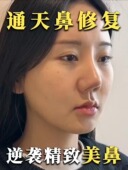 通天鼻修复矫正精华 改善山根过高不柔和立体美鼻精油