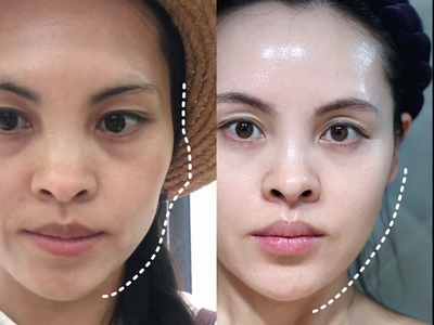 草本面部凹陷饱满精华 改善眼窝太阳穴鼻基底苹果肌泪沟额头塌陷