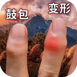 剑鞘用手指变形肿大关节粗大增生疼痛酸麻僵硬劳损鼓包专用膏贴