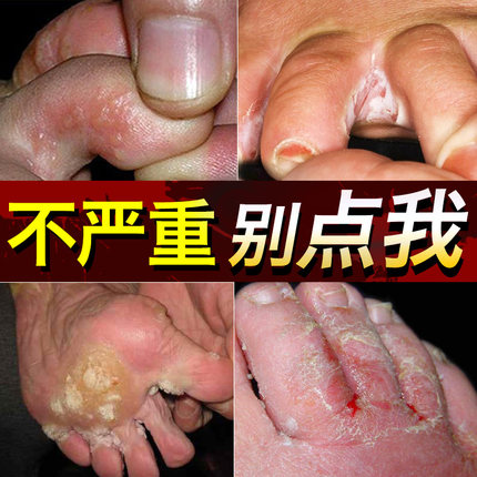 皮太夫脚氣手脚藓干裂水泡型脱皮烂脚止痒喷剂膏套装