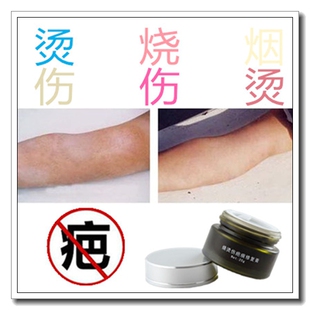 祛纹身贴肚子凸起硅酮凝胶医用遮盖剖腹产疤痕体质增生的疙瘩神器