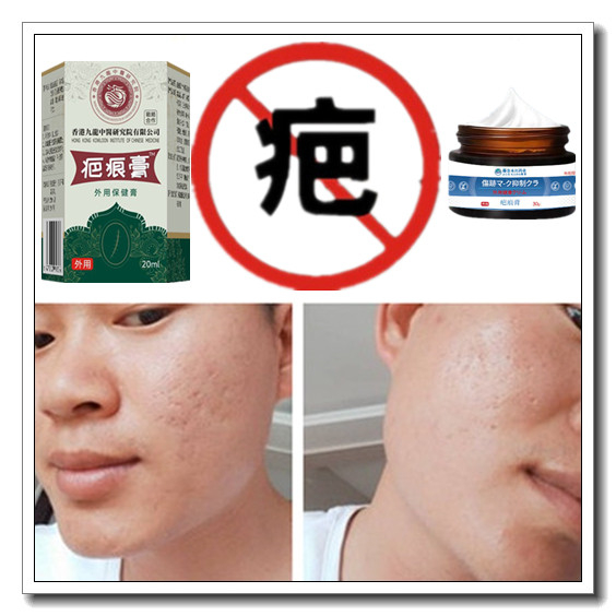 去除手术儿童增生凹凸疙瘩祛烧伤药烟烫疤痕印淡化激光缝针黑色素