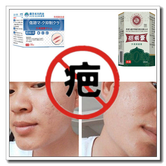 修复祛凸疤开伤疤痕印灵消除去增生性冻疮疙瘩手术产后色素药乳液