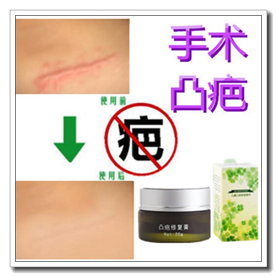 祛刀疤修复膏消除儿童烟疤痕遮盖贴敷料红印去增生肉疙瘩软化缝针