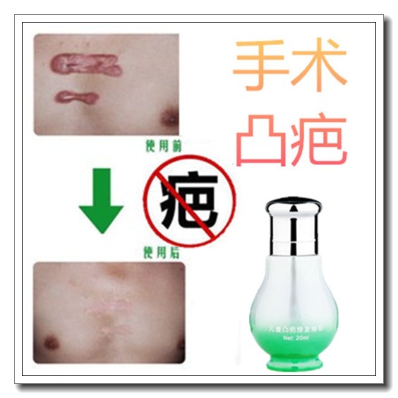 脸部缝针老疤可痕疤痕凝胶修复贴去除黑色素胡子印产品深层淡疤膏,洗护清洁剂/卫生巾/纸/香薰,其它,淘宝优惠券,粉丝福利购,淘宝优惠卷