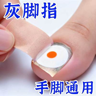【已愈100万人】指甲贴正品专用贴植物萃取脚趾手指甲专用