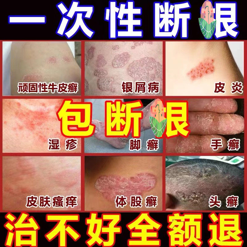 银专用膏银宵银血银削病银消银肖银雪硝银销藓毒痒克星药钱鲜鲜选