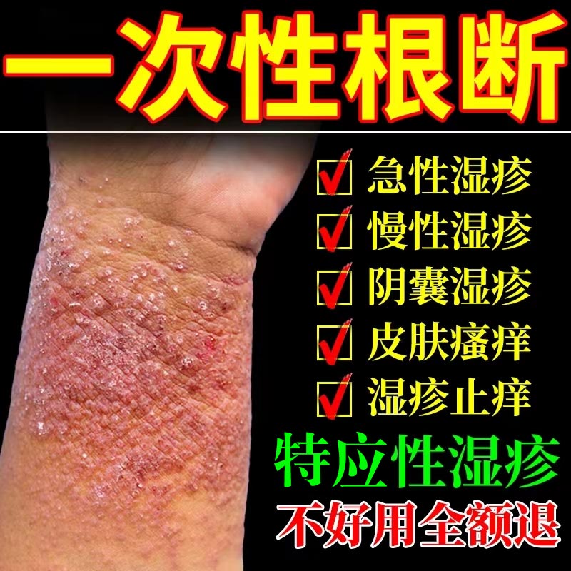 皮肤湿疹止痒去根瘙痒抑菌药膏顽固皮炎皮疹过敏红疹专用药外用膏