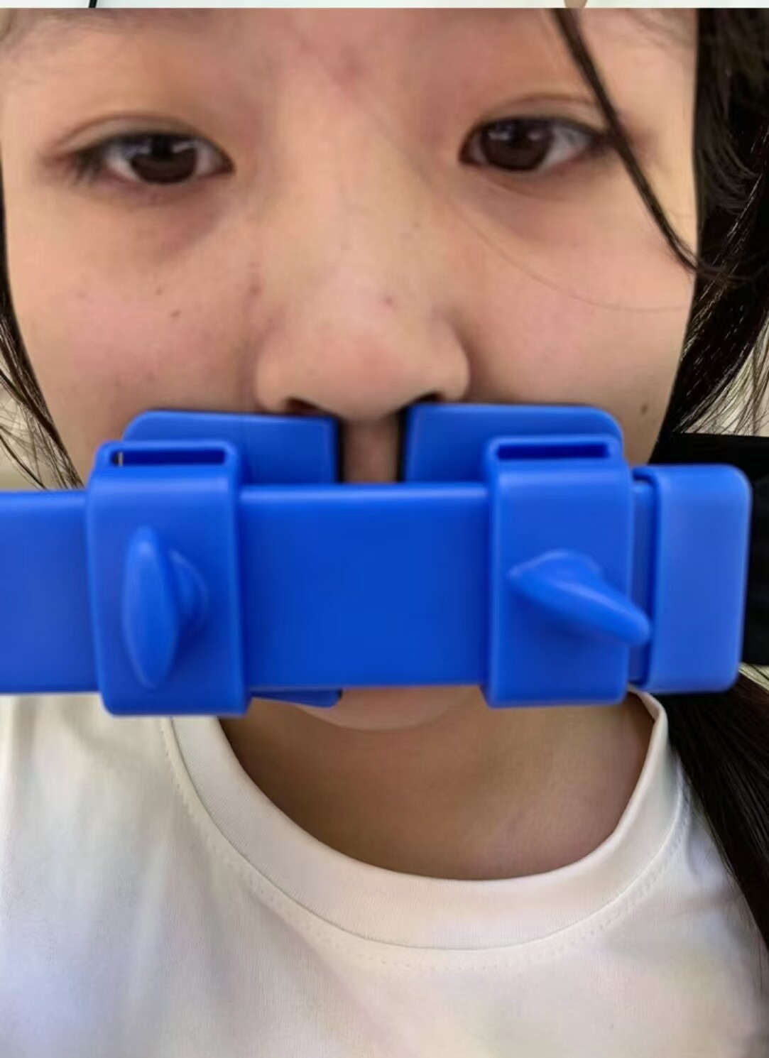 嘴凸牙凸牙齿不整齐全脸内推瘦脸器