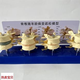 人体脊椎骨质疏松随年龄病变椎间B盘萎缩压缩突出腰椎神经骨骼骨