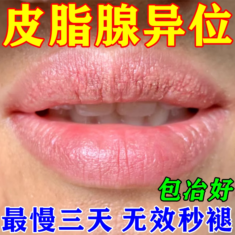 皮脂腺异位症嘴唇白点脂肪小颗粒皮脂腺增生嘴巴泡疹止痒去裉的药
