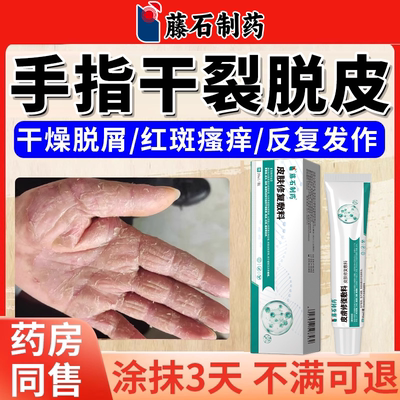 手癣膏脱皮干裂真菌感染鹅掌风专用膏药监备案足癣开裂起皮手痒YY
