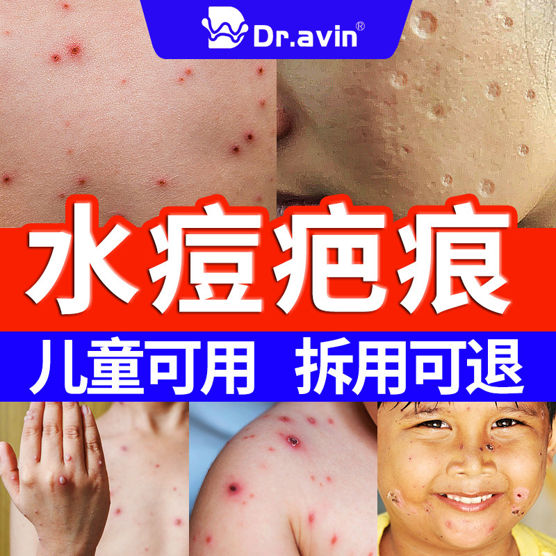 水痘疤痕去痘印祛痘印黑色素沉淀痘坑修凹陷性儿童成人淡化QQ