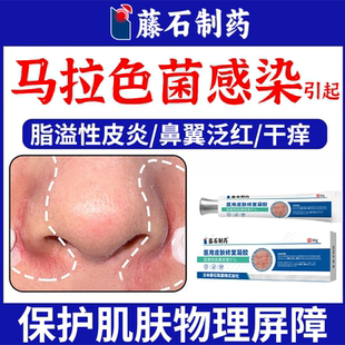 马拉色菌脂溢性皮炎面部护肤品鼻翼子两侧泛红脱皮干燥软膏ON
