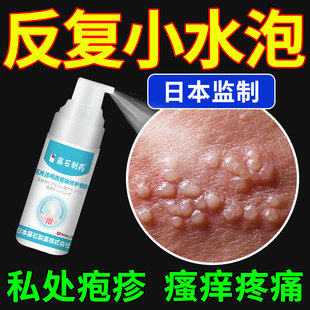 生殖器疱疹疱疹清克喷雾真菌感染男女防复发中可搭膏药贴单纯QQ
