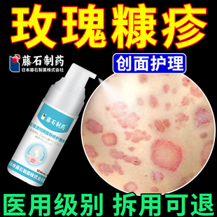 玫瑰糠疹喷雾专用皮肤瘙痒抓破创面护理红斑鳞屑搭沐浴露膏药贴ON