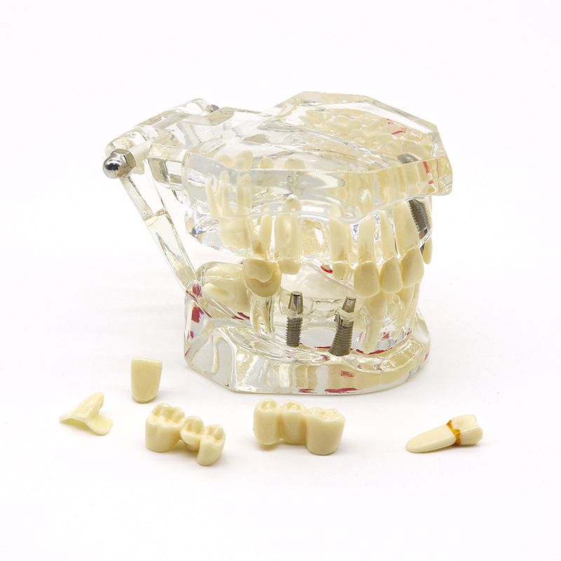 牙科教学模型综合病理模型